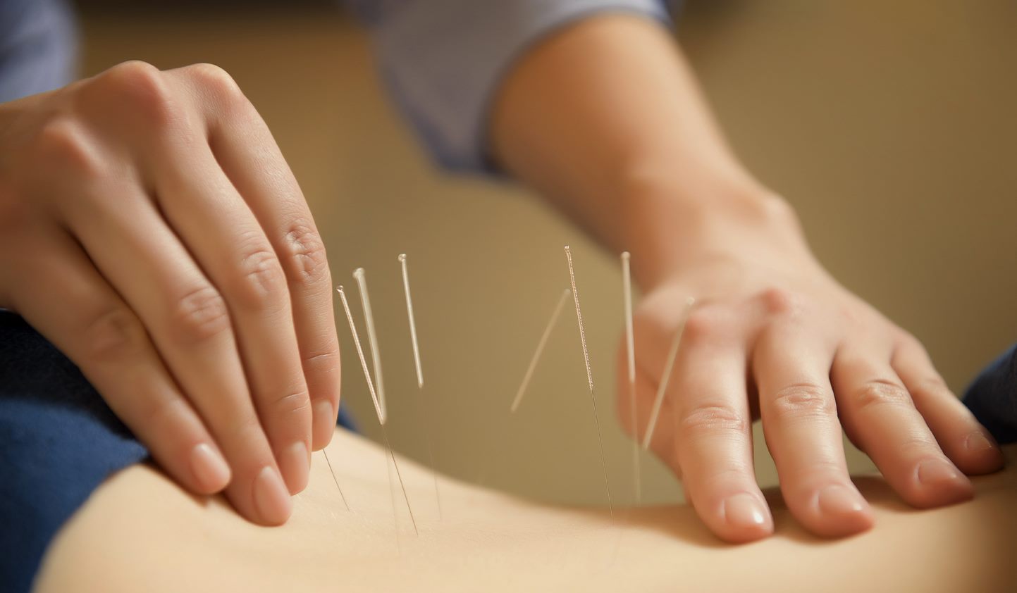 Acupuncture treatment at Bodywell